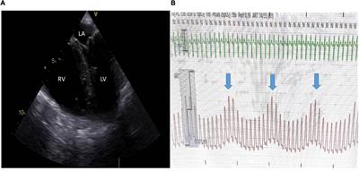 Right Ventricular Function in Acute Respiratory Distress Syndrome: Impact on Outcome, Respiratory Strategy and Use of Veno-Venous Extracorporeal Membrane Oxygenation